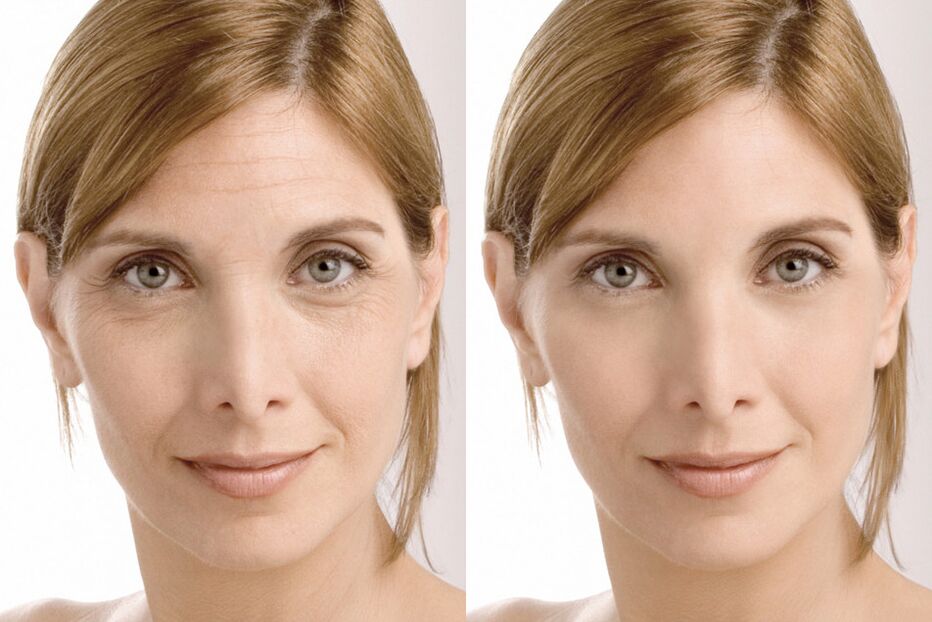 Experience before and after using Milana's intenskin cream
